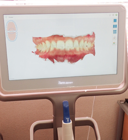 口腔内スキャナー「iTeroエレメント2」